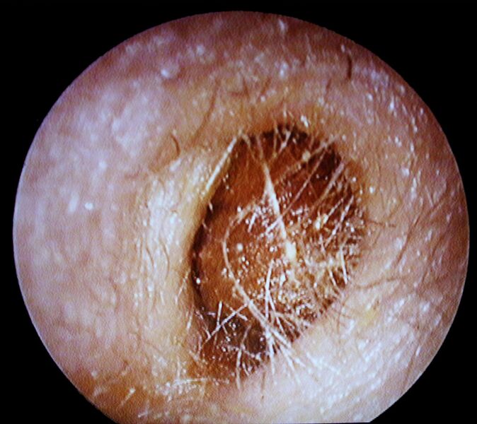 Datei:1011px-BouchonCerumen.jpg