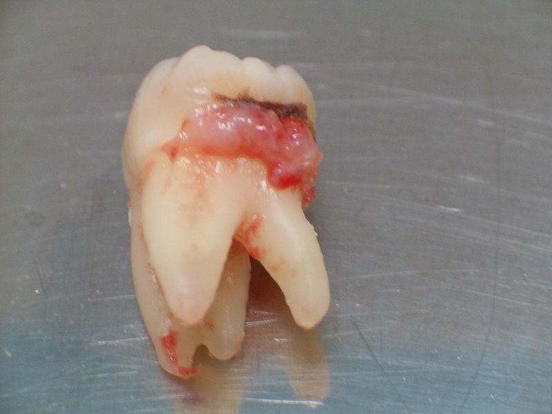 Datei:Molar quatro raízes.jpg
