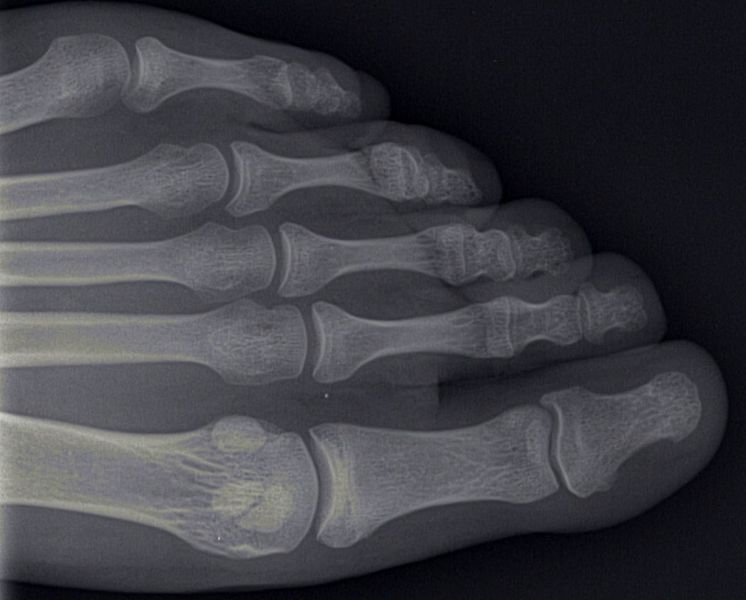 Datei:Zehenknochen-xrayS0 I0.JPG