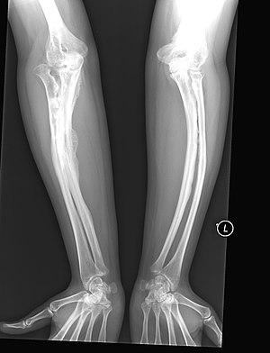 osteogenesis imperfecta rntgenbild anthrowiki typ erwachsenen arme