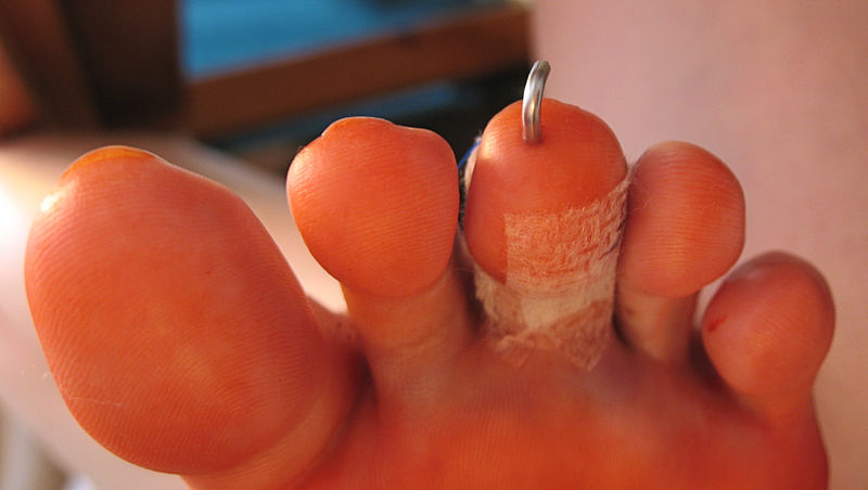 Datei:Hammerzehe nach OP.JPG